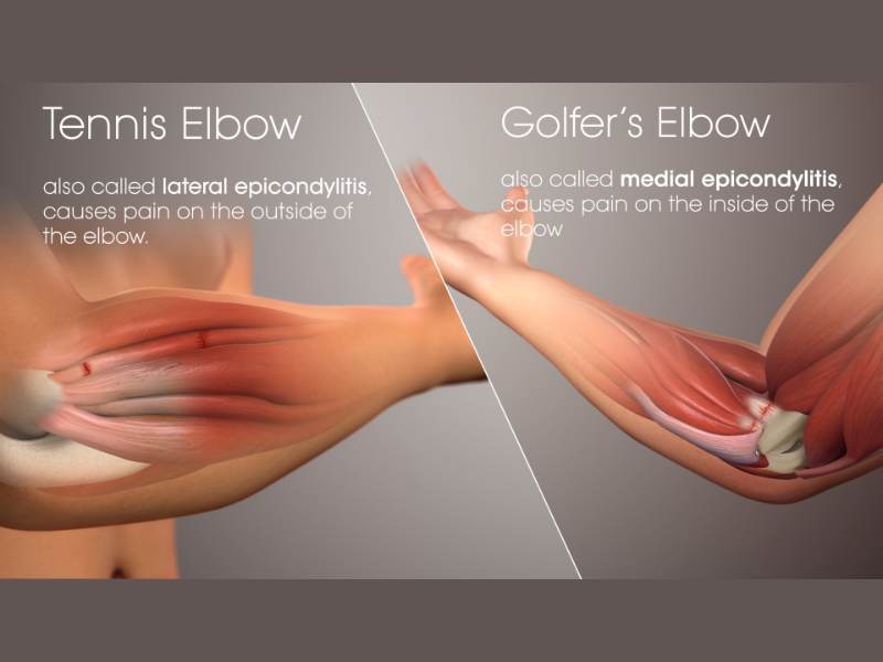Exercise for golf elbow